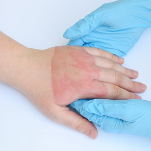Minor Burns Treatment in Brunswick, GA and St. Simons Island, GA