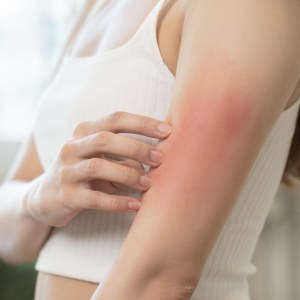 Rashes Treatment in Brunswick, GA and St. Simons Island, GA