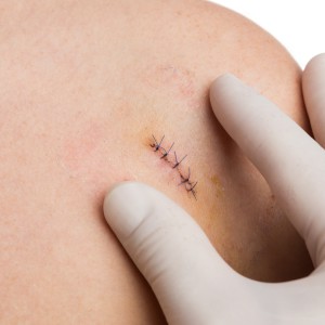 Sutures Treatment in Brunswick, GA and St. Simons Island, GA