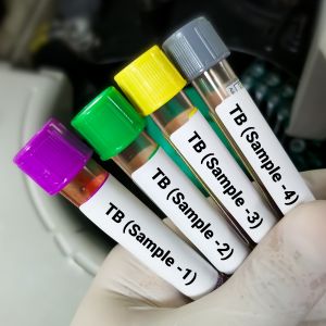 Tuberculosis Screening in Brunswick, GA and St. Simons Island, GA