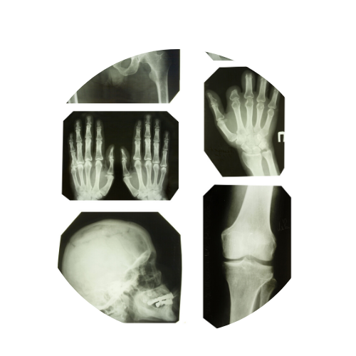 xray of broken wrist